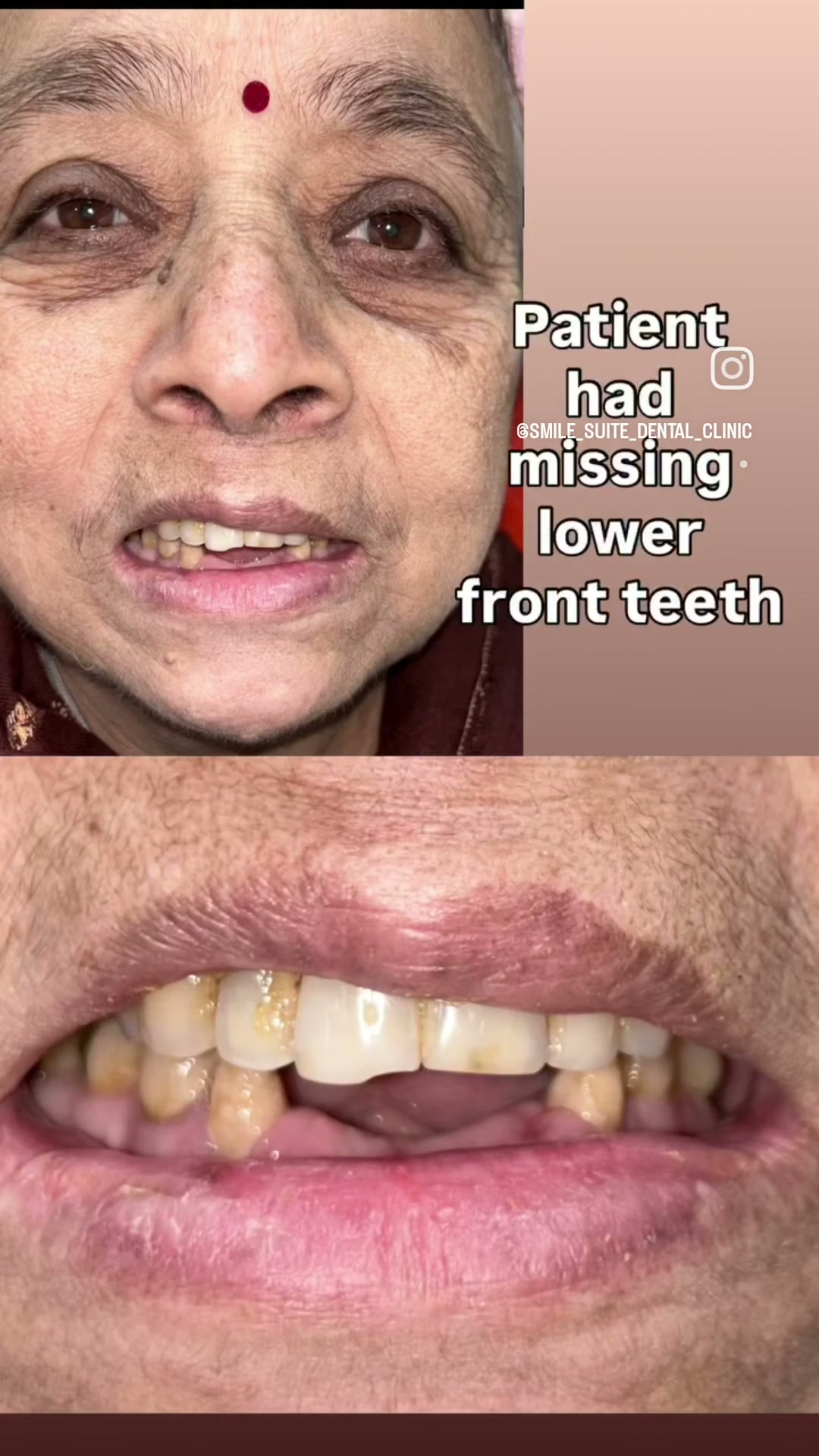 Dental restoration patient journey at Smile Suite Dental Clinic
