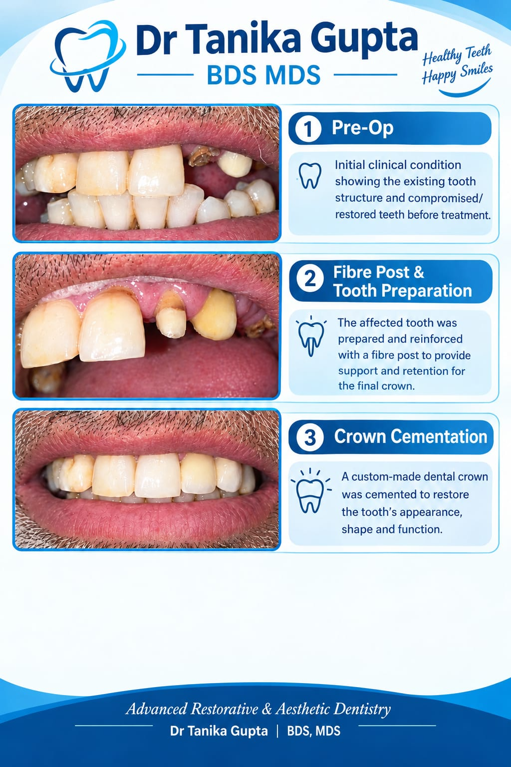 Three-stage restorative treatment showing the initial condition, fibre post preparation and final dental crown