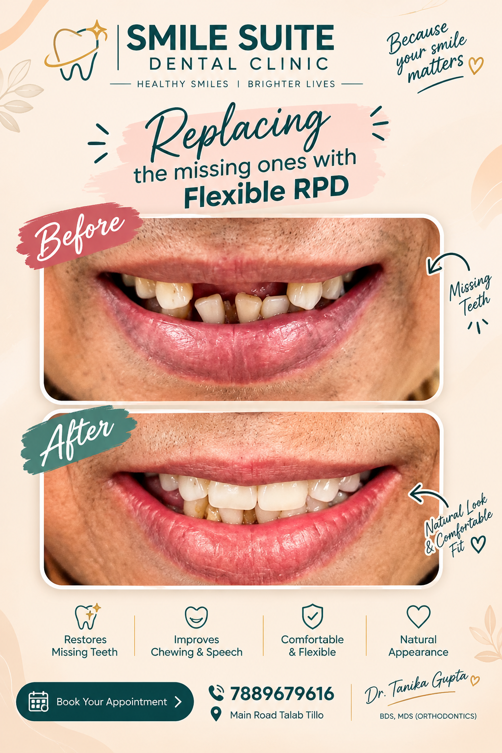 Before and after of a flexible partial denture replacing missing front teeth