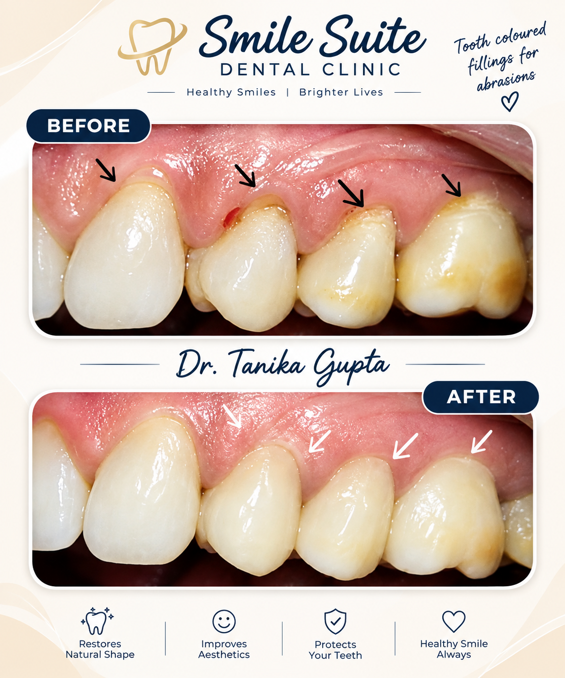 Before and after of tooth-coloured fillings restoring worn front teeth