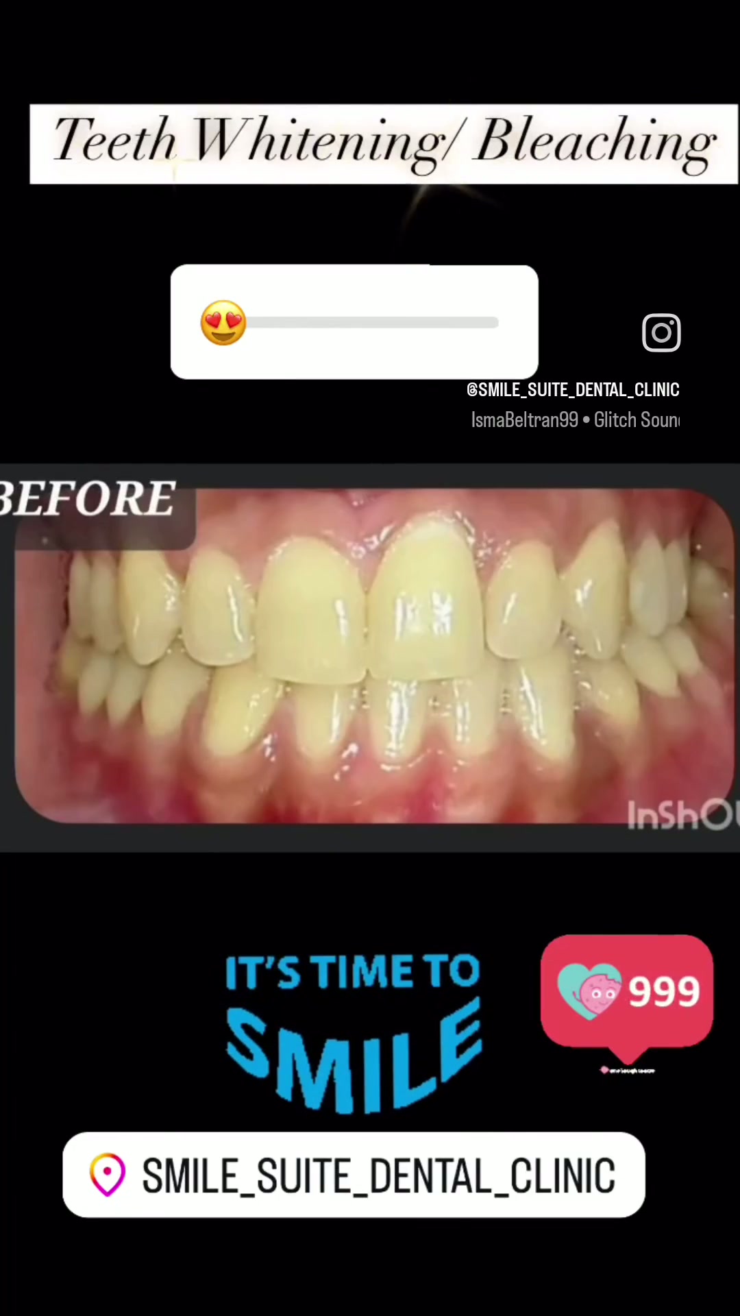 Teeth whitening result at Smile Suite Dental Clinic