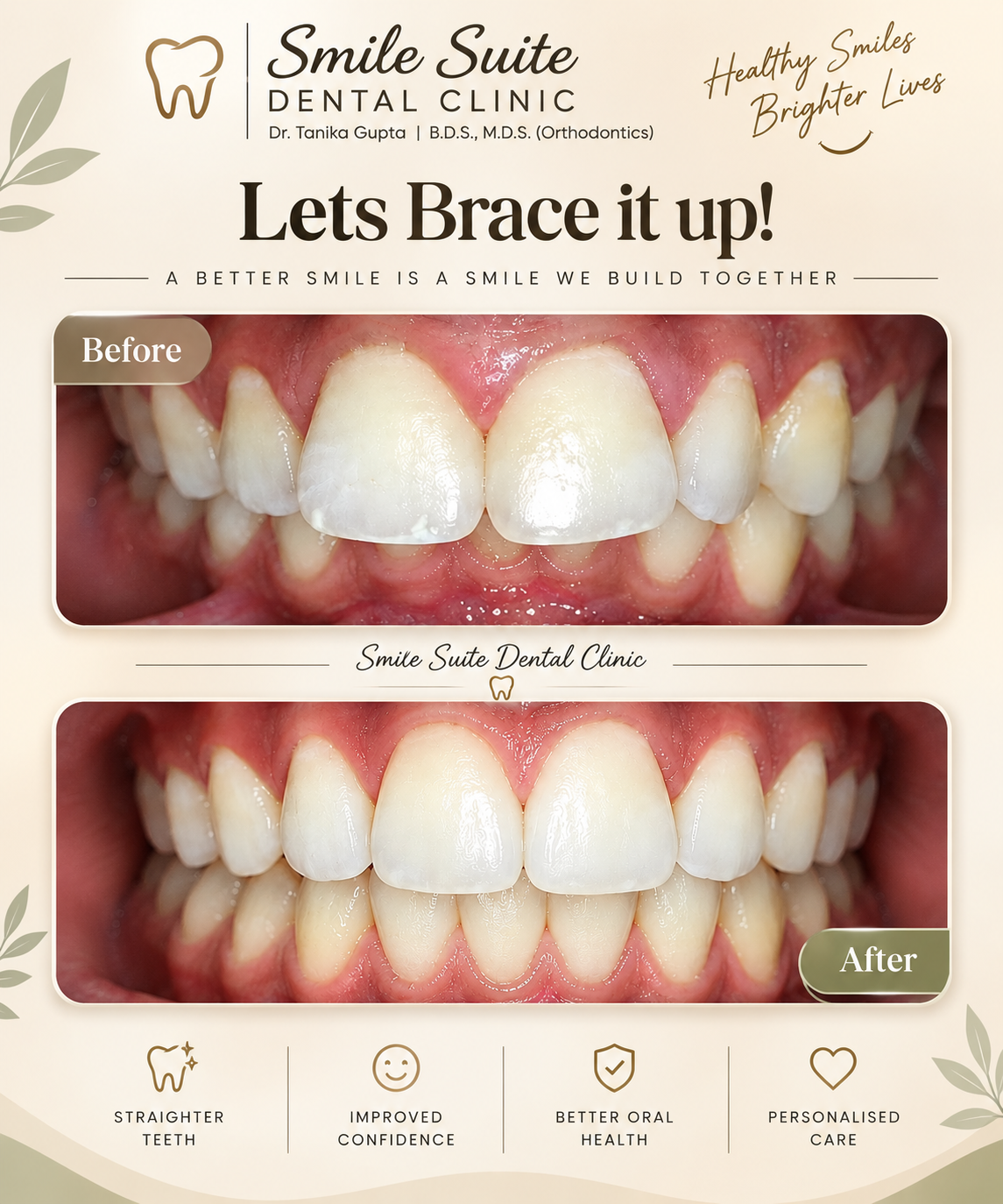 Before and after of braces correcting crowded, misaligned teeth