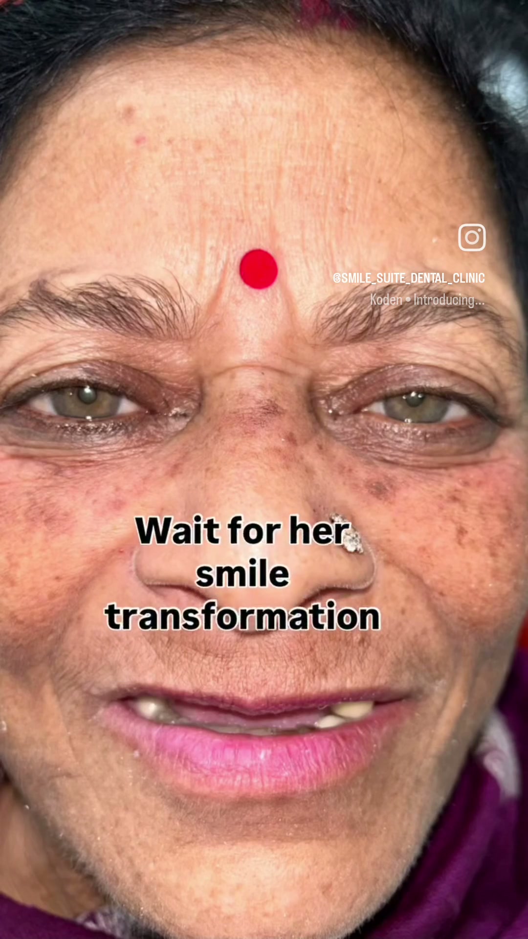 Patient smile transformation journey at Smile Suite Dental Clinic