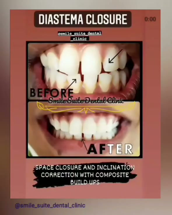 Before and after diastema closure treatment