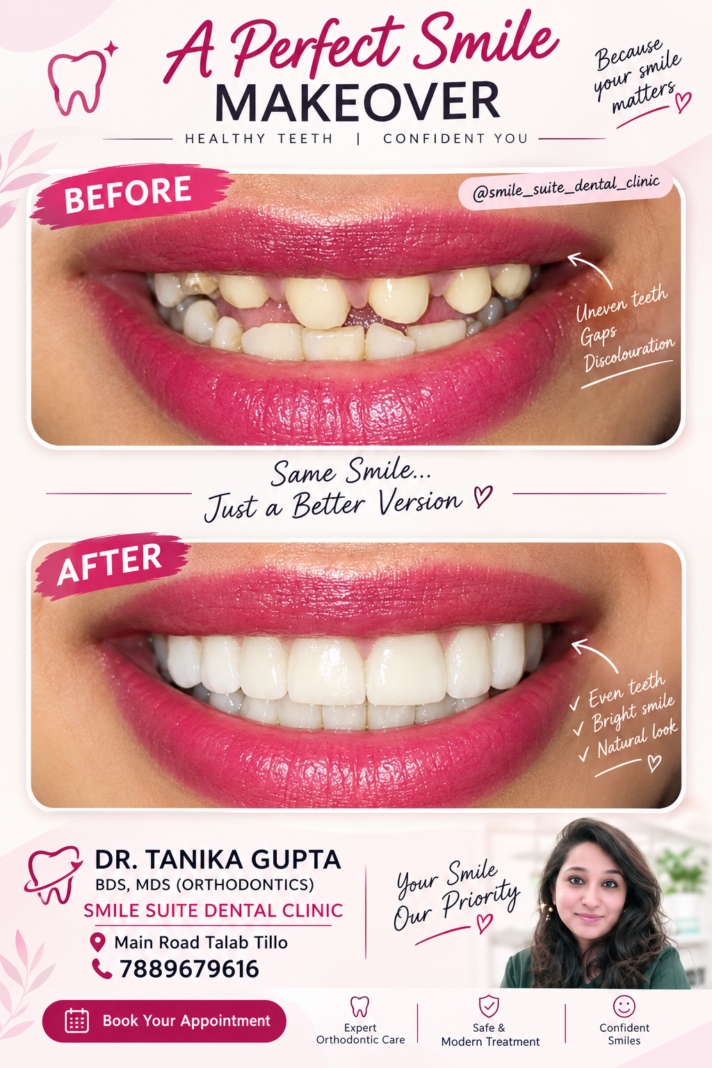 Before and after of a smile makeover with even, brighter teeth